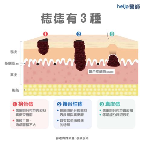 身體:acsf1ltef_m= 痣的位置|痣形成的原因？痣長毛、痣變多變大是痣病變？5招判別